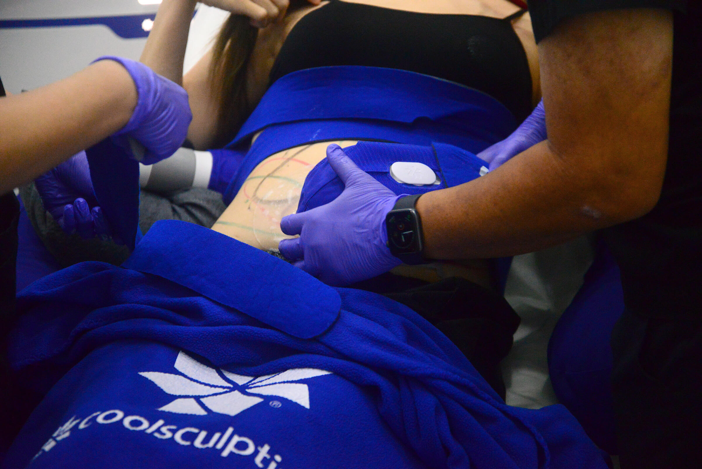 Halley Body Slimming Clinic | The Side Effects of Fat Freezing Treatments: What You Need to Know