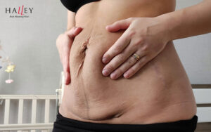 Woman holding loose abdominal skin following pregnancy for tightening.