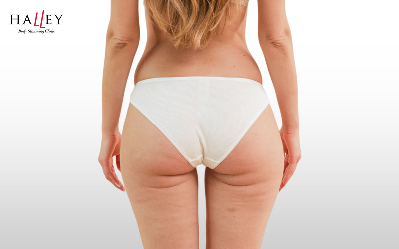 Back view of a woman showing banana roll fat area